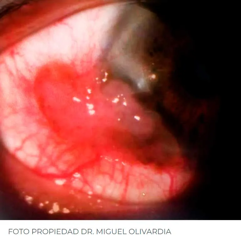 Superficie ocular de un paciente tras biopsia excisional, alcohol absoluto, crioterapia y colocación de membrana amniótica